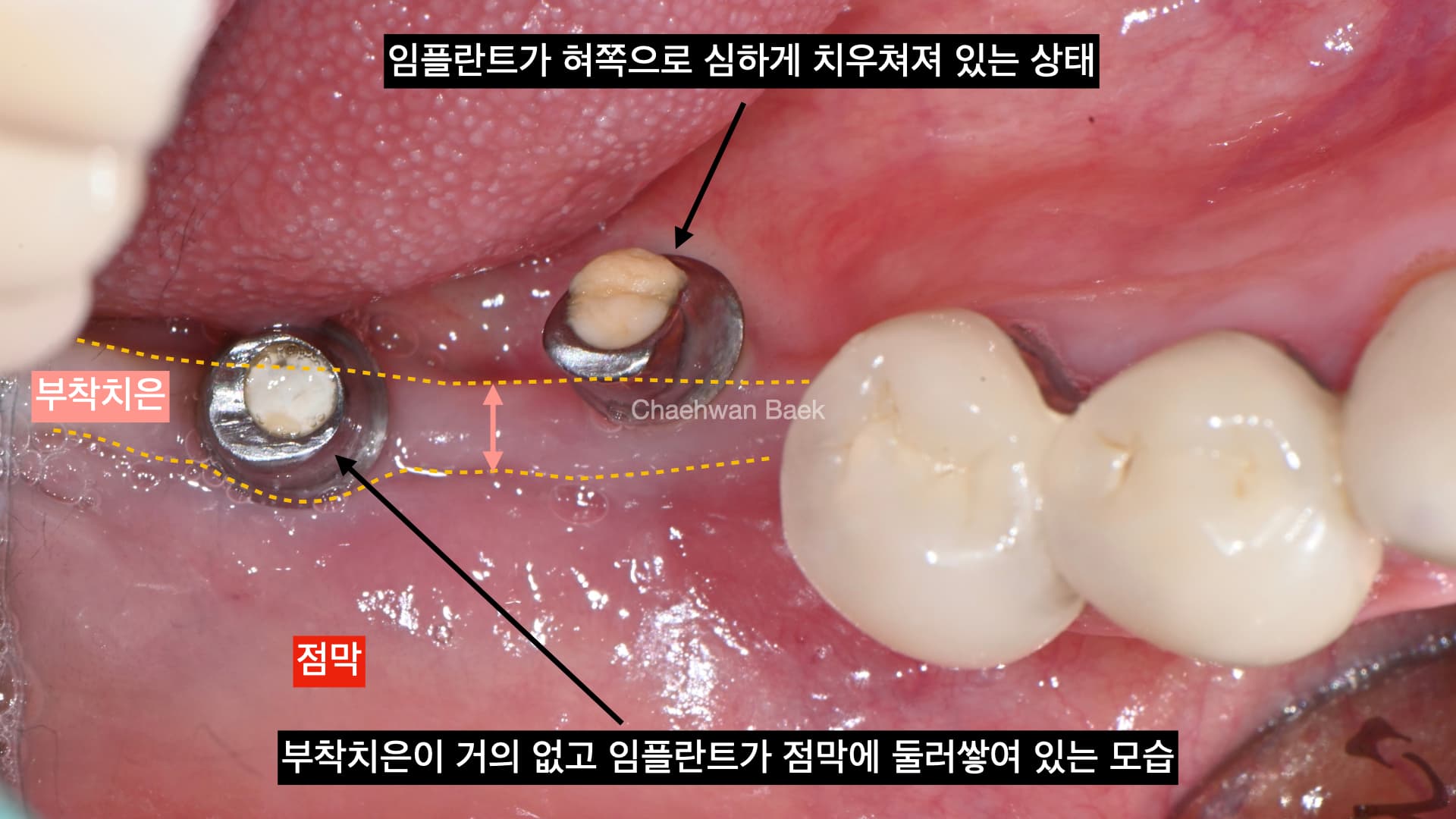 임플란트 주위염으로 인한 뼈 소실 임상사진 1 — 재수술 임플란트