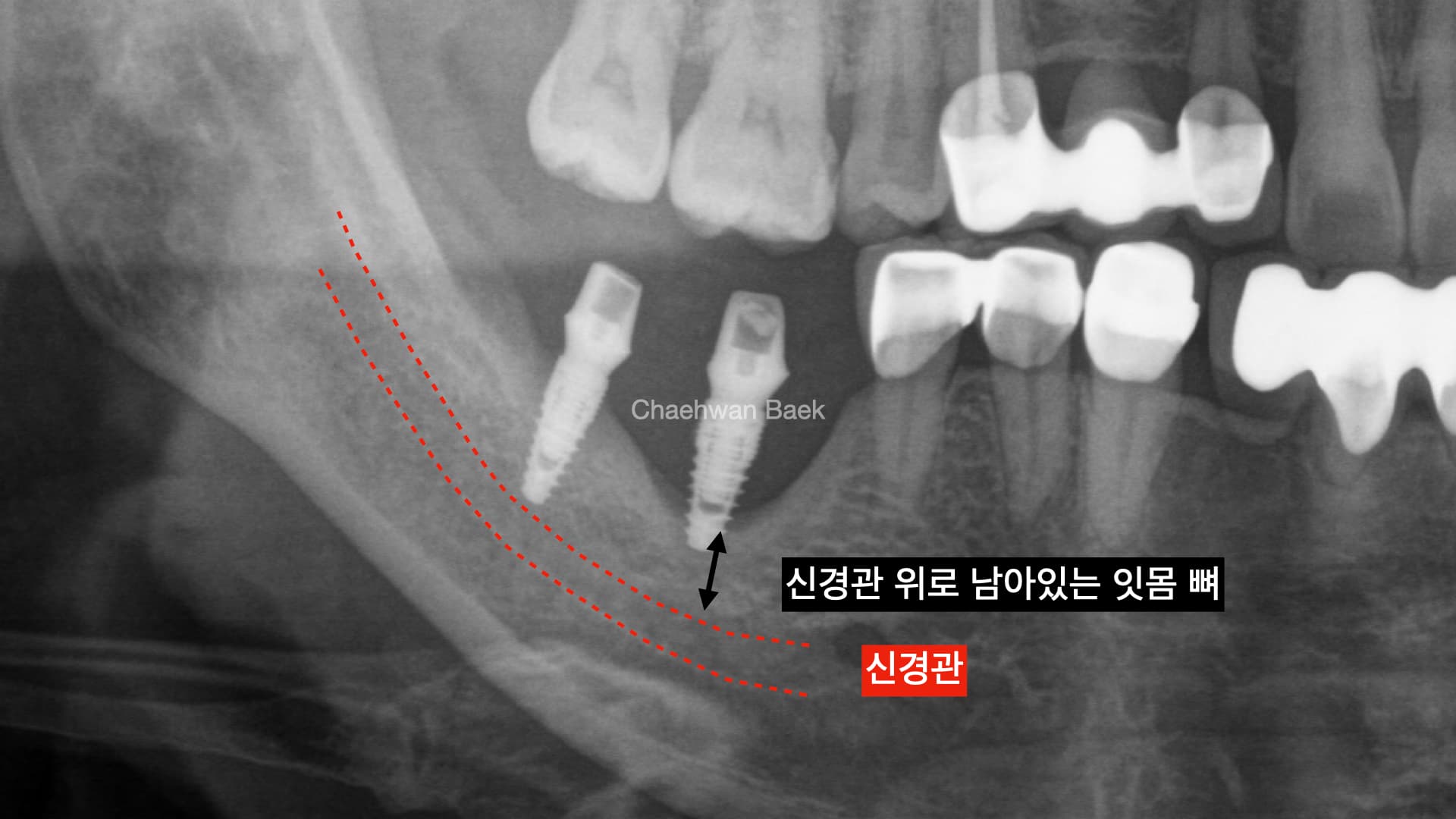 임플란트 주위염으로 인한 뼈 소실 임상사진 2 — 재수술 임플란트