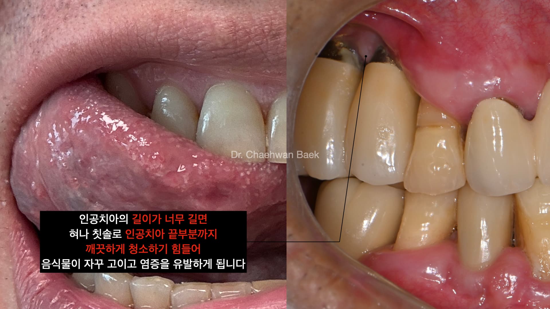 수직골 재건 없이 시행한 재수술 임플란트 — 인공치 길어서 음식물 고임
