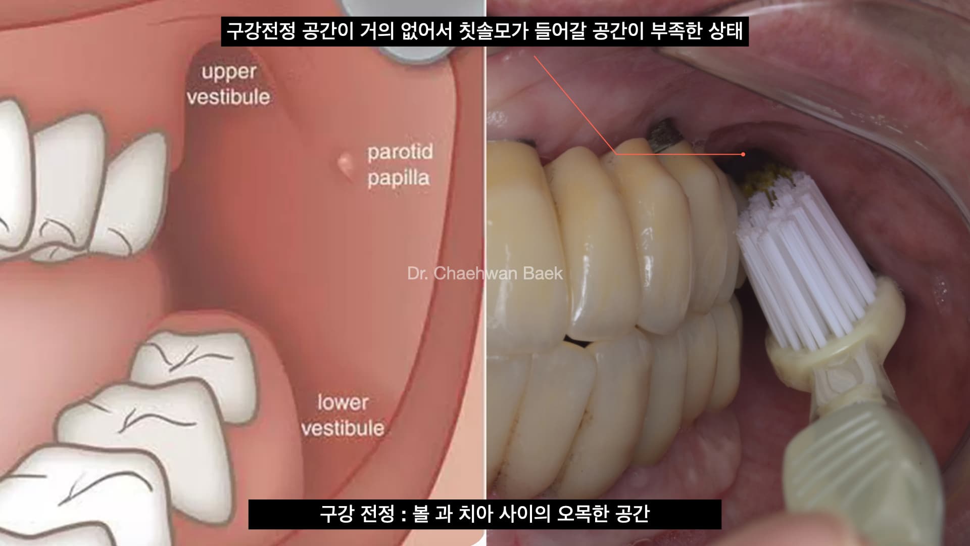 잇몸 재건 없이 시행한 재수술 임플란트 — 구강전정 공간 부족