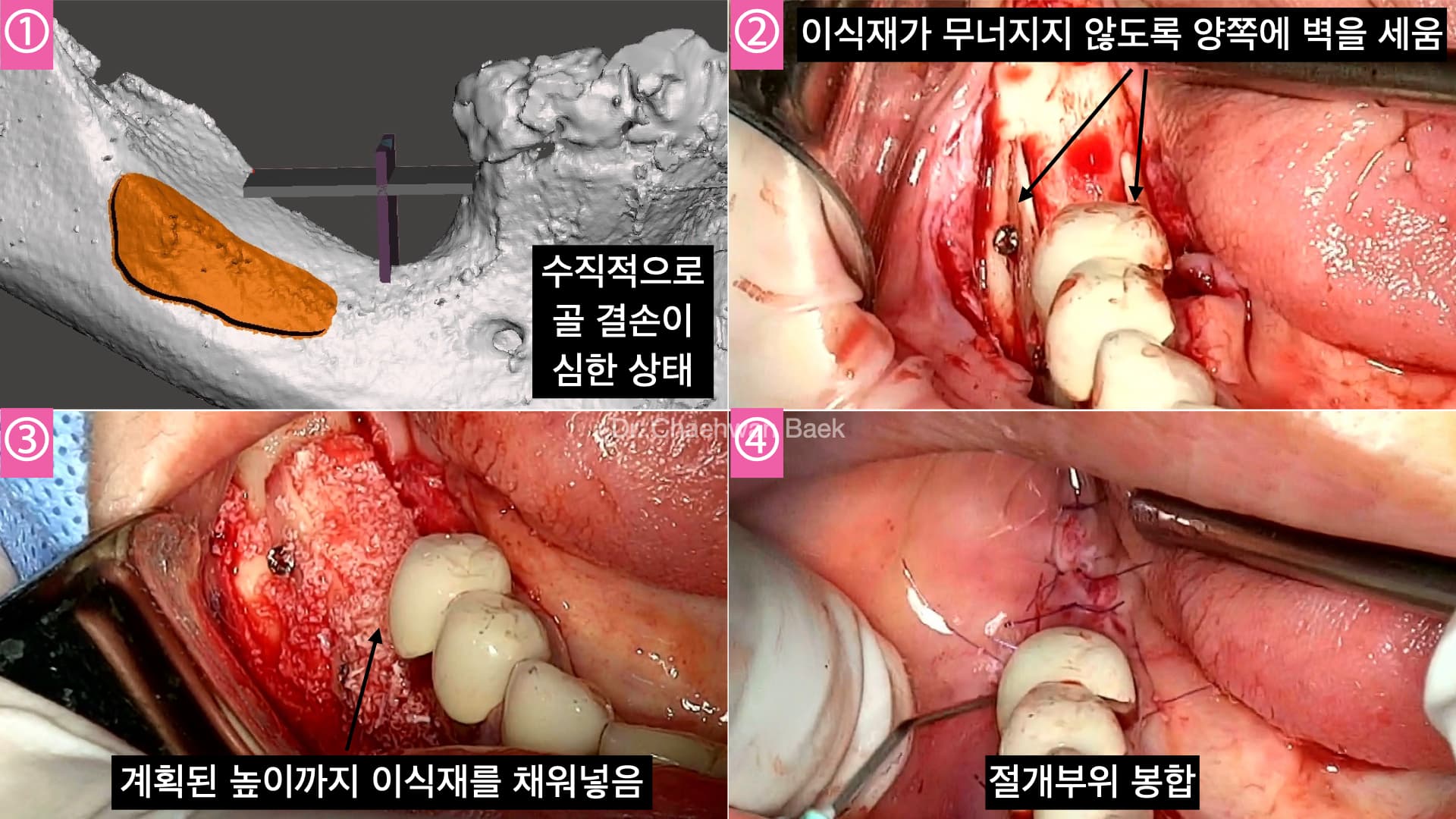 수직골 거상술 — 재수술 임플란트 수직 뼈 재건 과정