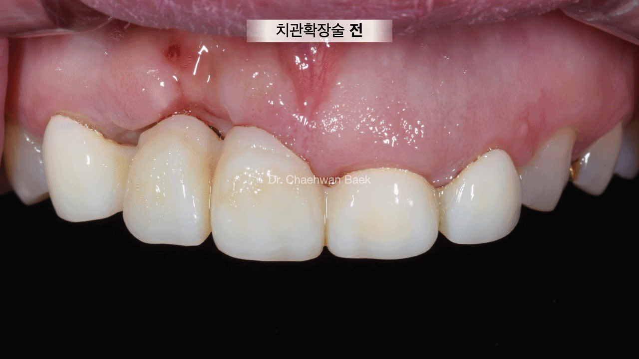 치관 확장술 — 잇몸라인 성형으로 치아 비율 및 심미 개선