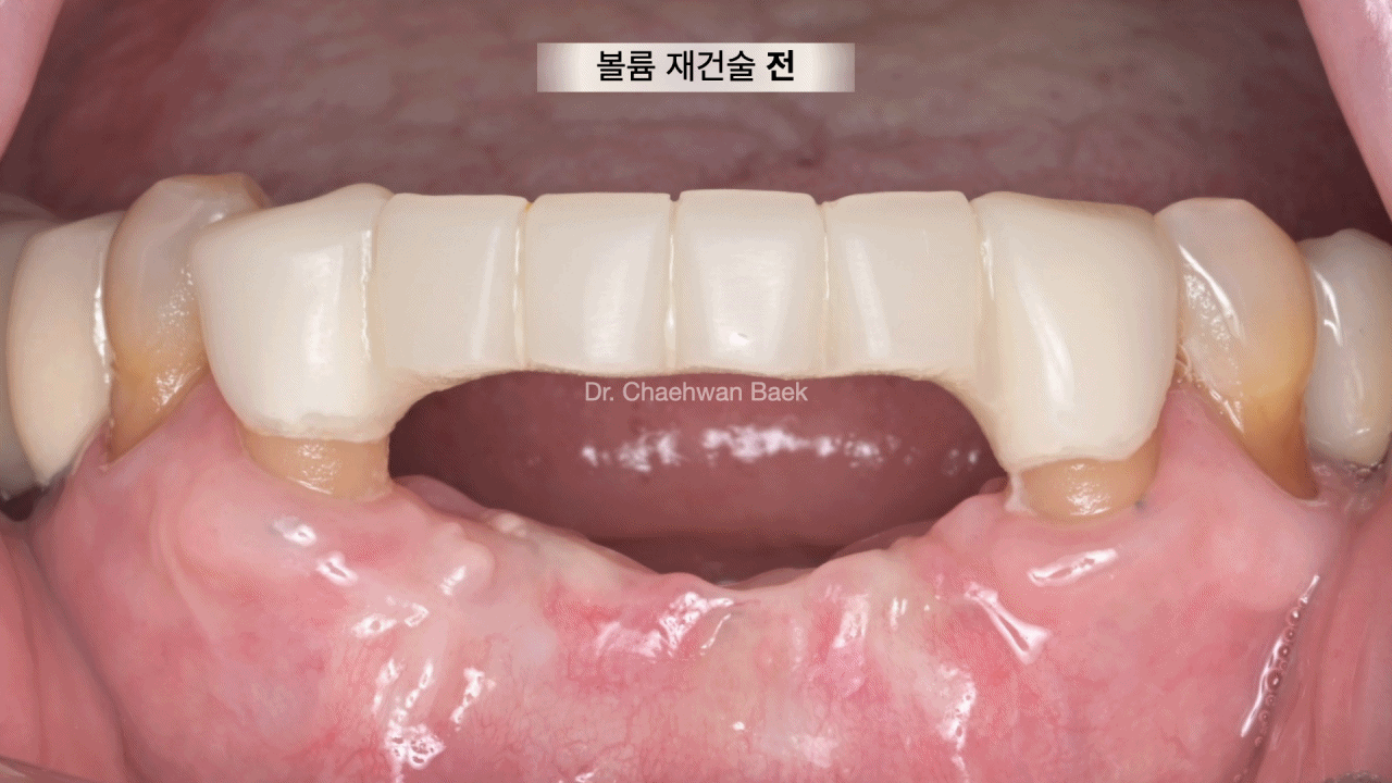 볼륨 재건술 — 임플란트 및 자연치 주변 꺼진 잇몸 볼륨 회복