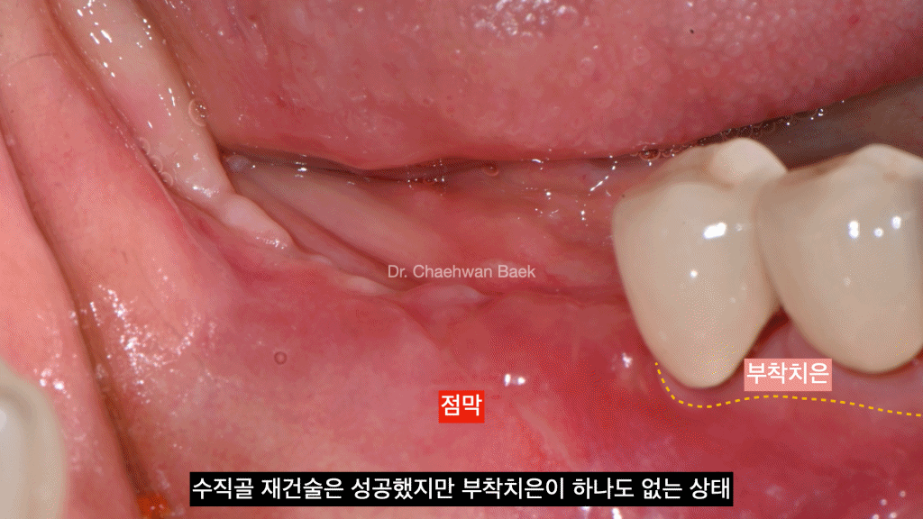부착치은 재건술 — 재수술 임플란트 잇몸 재건 과정