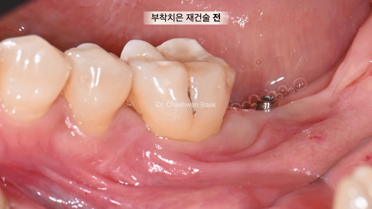부착치은 재건술 — 유리치은이식술로 임플란트 주변 부착치은 폭 확보